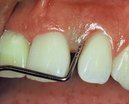 Tener periodontitis eleve un 25% el riesgo de padecer enfermedades cardiovasculares