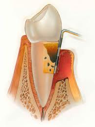 Que es la periodontitis o piorrea