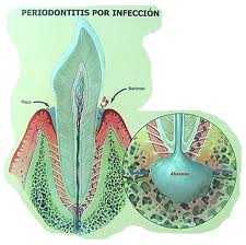 Qué es la periodontitis